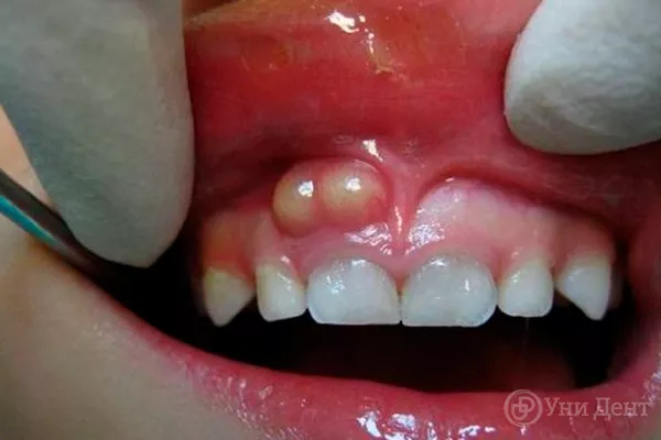 Как лечат зубные каналы?